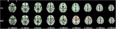 White Matter Integrity Involvement in the Preclinical Stage of Familial Creutzfeldt–Jakob Disease: A Diffusion Tensor Imaging Study